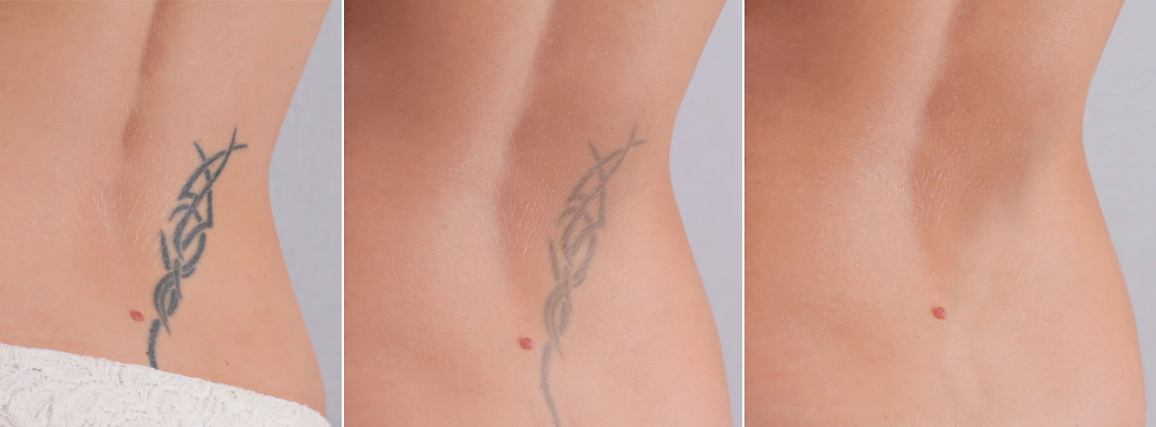 Tattoo Removal Aftercare