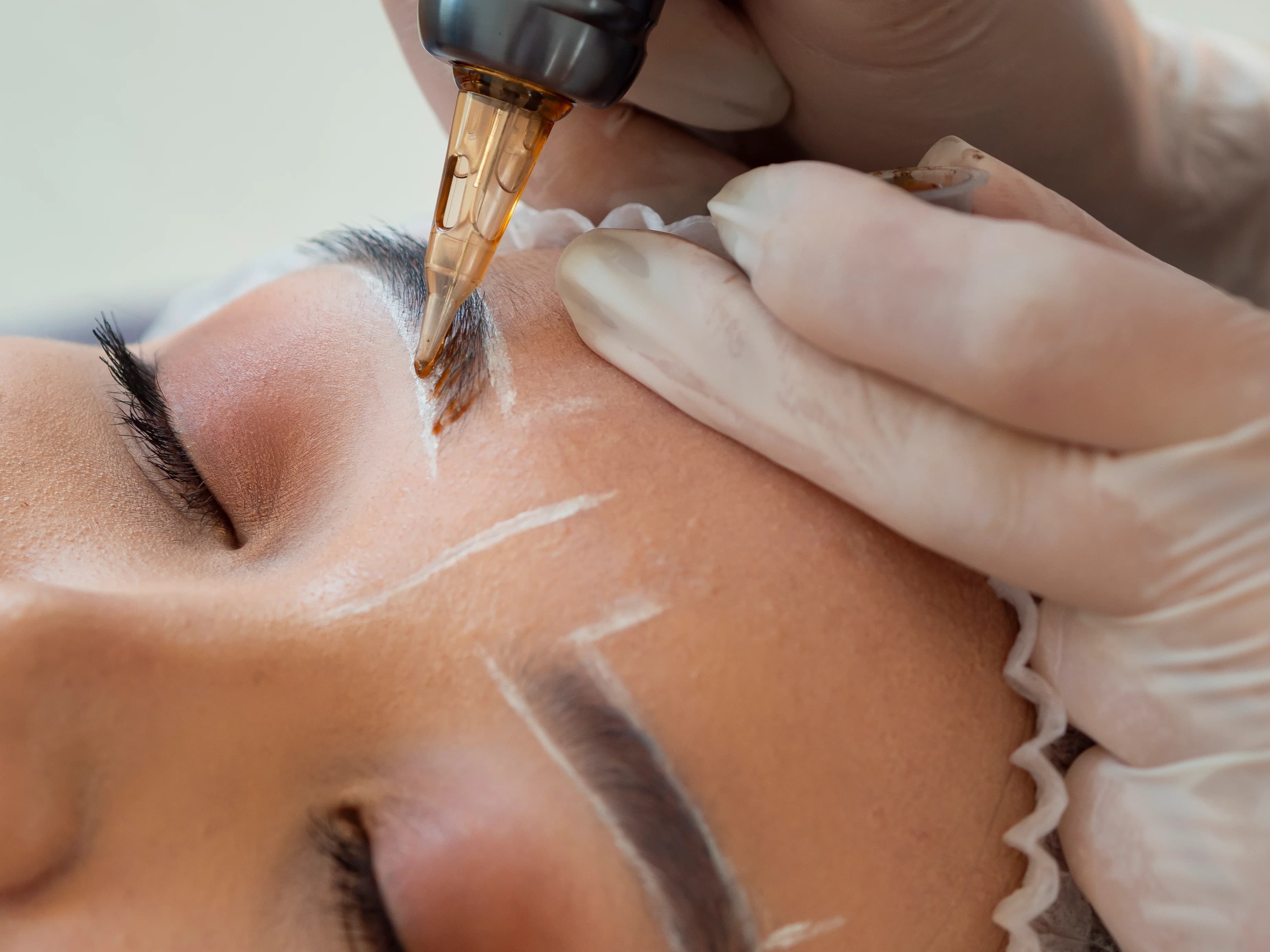 Saline Tattoo Removal
