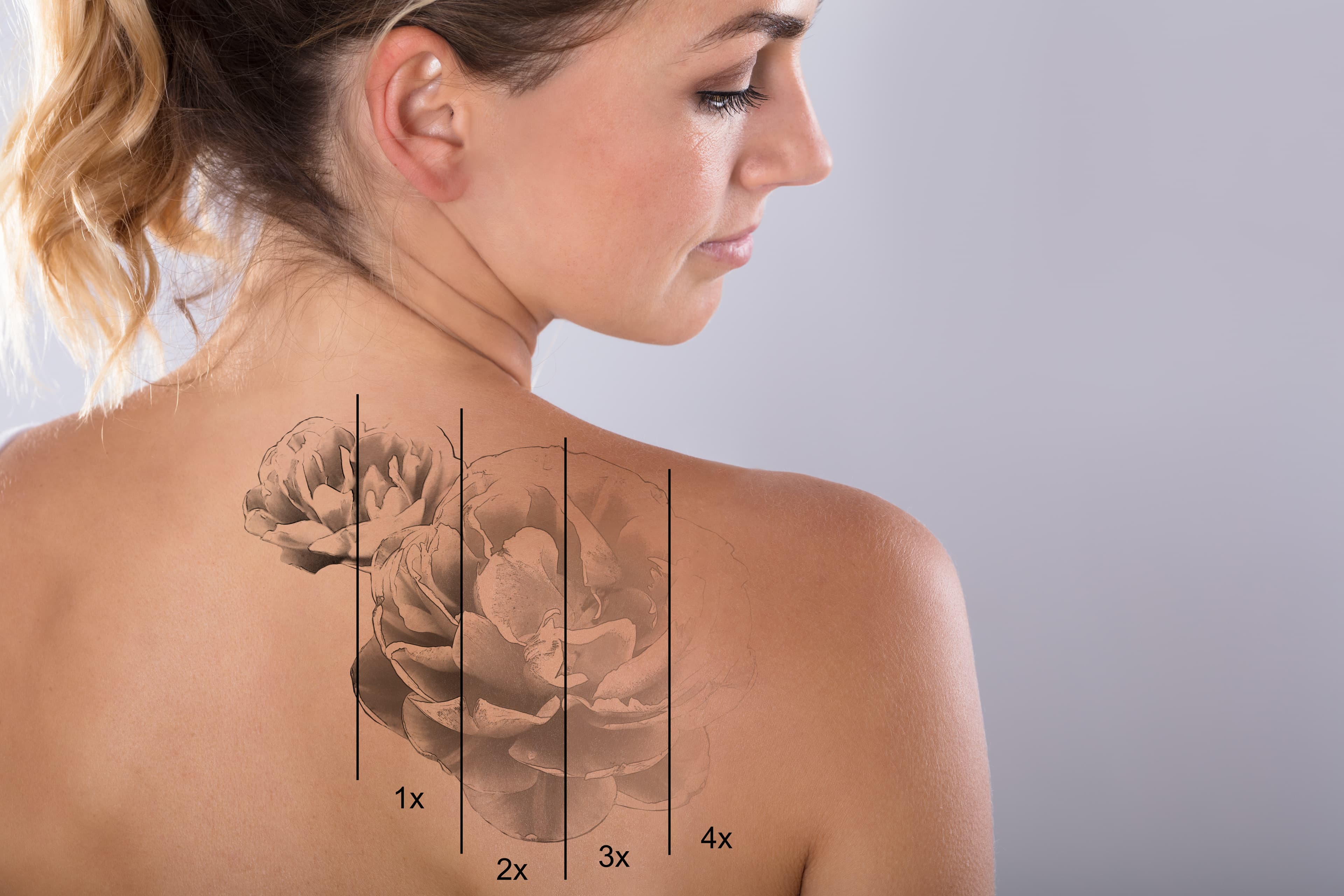 The Tattoo Removal Healing Process