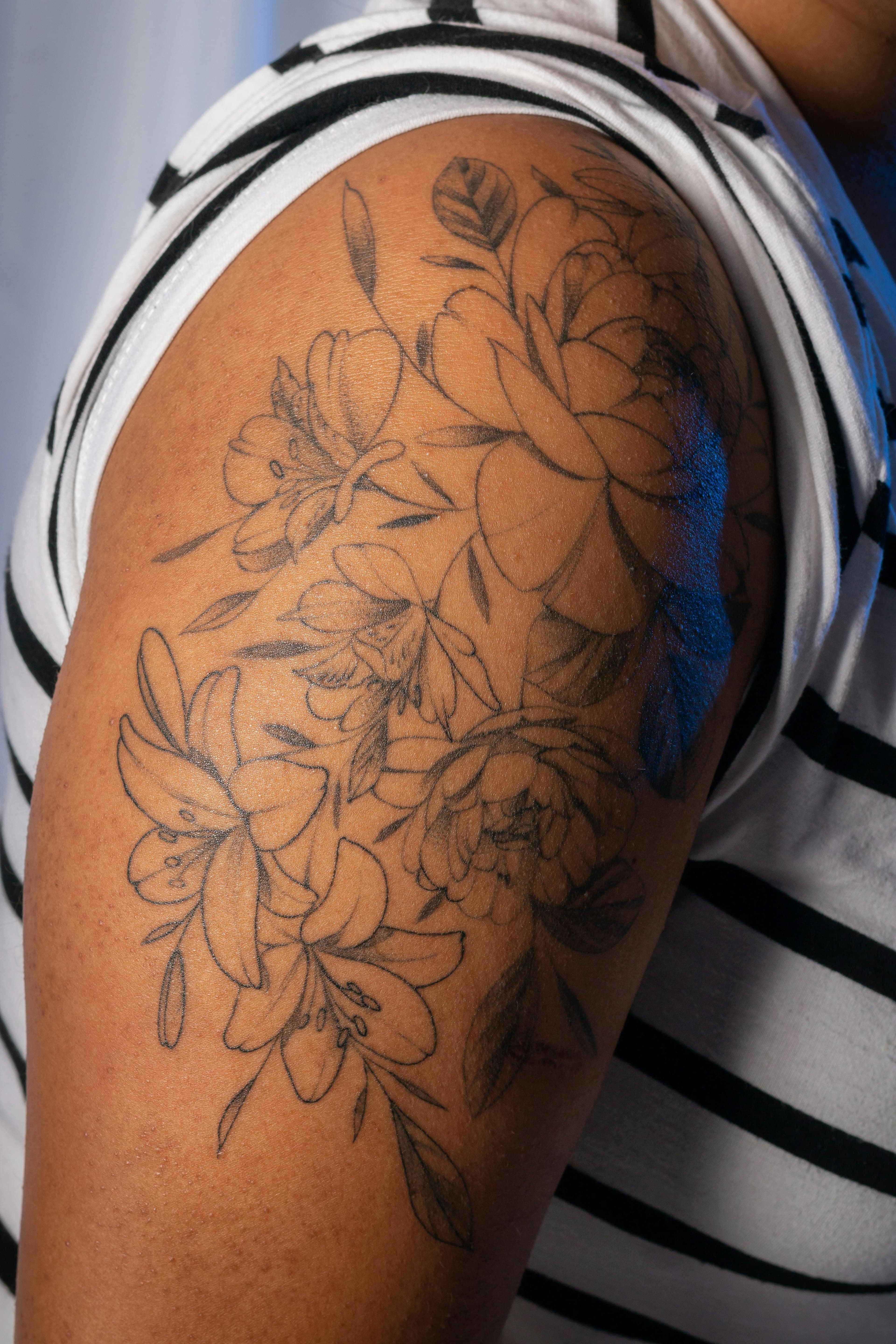 Laser tattoo removal on darker skin tone Fitzpatrick IV to VI