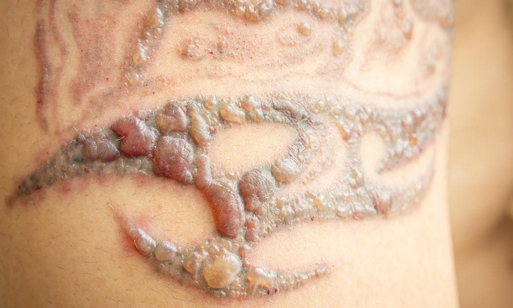 Tattoo Removal Scarring